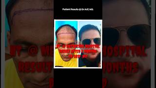 Patient results @DrArifMDDermatologist #hairtransplant #hairfall #acne #shorts