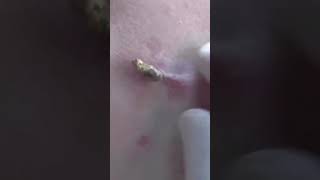 Blackheads Big