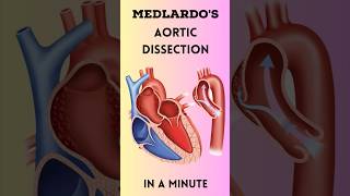 Aortic dissection in a minute #medicine #doctor #medschool #medstudent #nurse #aorticdissection