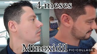 Minoxidil Kirkland 4 meses de uso