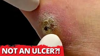 You'll Never Guess What This REALLY Is!! Not An Ulcer?! 😲 | Dr. Kim, Kim Foot and Ankle