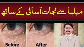 What Is Milia? | Causes, Symptoms And Treatment Of Milia | Dr Faisal Syed | Health Matters