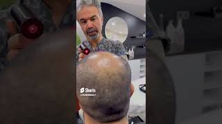 Hair Transplant Turkey | Best Hair Transplant in Turkey | Before-After #hairtransplant #shorts