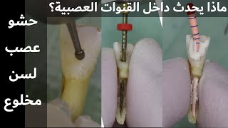 خطوات حشو العصب للأسنان الأمامية وماذا يحدث داخل القنوات العصبية ؟Root Canal Treatment for teeth