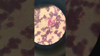 Platelets clumping | platelets on smear | what is platelets