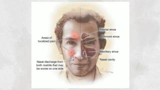 tratamiento para la sinusitis