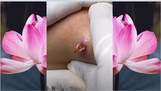 How to remove blackheads at home - Buz Dağı gibi sivilce!! Sivilce sıkma sivilce patlatma videosu.