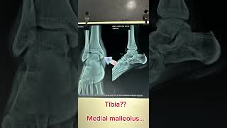 Medial malleolus fracture.