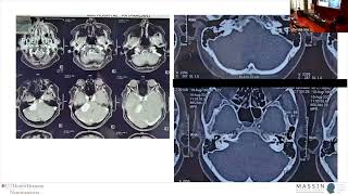 CP Angle Tumour: Vestibular Schwannoma | MASSIN Congress Day 2 | Session 4, Talk 2