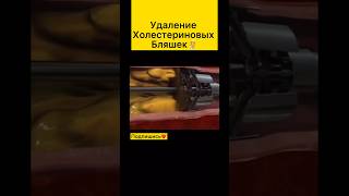 Вот как сосуды чистят от - Холестериновых  бляшек🧑‍⚕️ #медицина #хирург