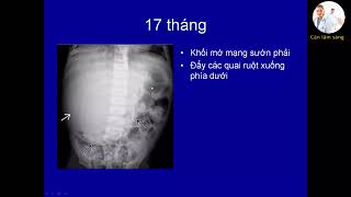 U nguyên bào gan trẻ em | TS. BS. Trần Phan Ninh