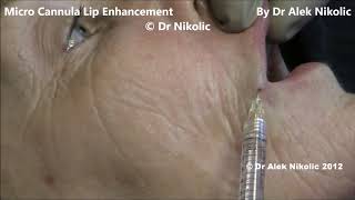 Micro Cannula Lip Enhancement Volume and Border De