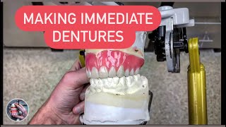 making immediate upper denture (surgical dentures)  تنضيد اسنان لبدلة اسنان مباشرة بعد القلع #WAXBAE