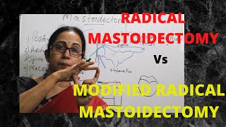 070.Radical Mastoidectomy Vs Modified Radical Mastoidectomy  #mastoidoperations #surgeryeducation