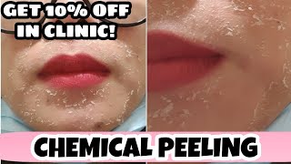 Chemical Peeling Treatment in London || Get 10% OFF treatment in Clinic!