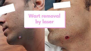 Huge wart/ मस्सा removal by laser || How to remove  wart without spreading infection..