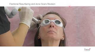 [Việt Can Thẩm Mỹ]_Fractional Ablative Resurfacing and Acne Revision