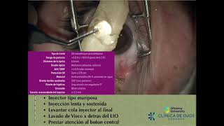 Resultados Nueva LIO Edof Refractiva LUCIDIS