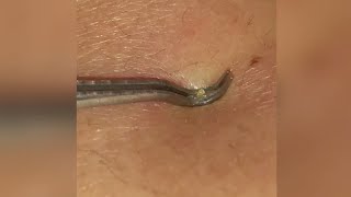 Compilation - Poping and Squeezing blackheads and whiteheads