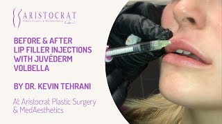 Lip Filler Juvéderm Volbella Injections Long Island, New York by Dr. Kevin Tehrani