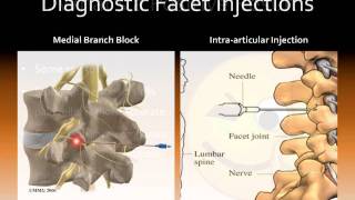 Lumbar Facet Joint Nerve Injections for Treating Chronic Low Back Pain