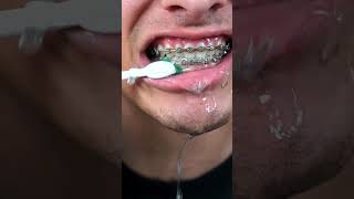 Cleaning buildup off my braces 😭