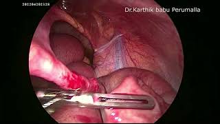 Patent Meckels Diverticulum band Causing intestinal obstruction