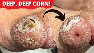 DEEP-Seated Corn Removal On Pinky Toe! (MUST WATCH)