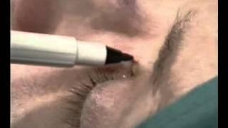 Scar Revision.wmv