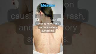 Measles │ Selected medical terminology │ #medicalterminology #measles  #short