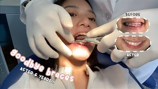 getting my braces off after 6 YEARS 🦷 (philippines)