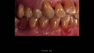 Replacing broken posterior teeth with a dental bridge // Case of the Month