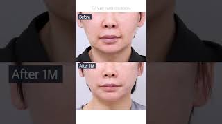 [B&A] Facelift in Korea Plastic Surgery #shorts