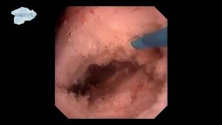 Incision of a Stenotic Calyceal Infundibulum