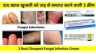 3 Best Cheapest Fungal Infection Cream | दाद खाज खुजली को जड़ से समाप्त करने वाली 3 क्रीम