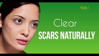 How to Get Rid of Acne Scars & Acne Marks FAST  || What It Takes