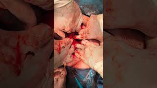 Pelvic Vascular Lecture in Percretas , ligation of all vessels to the uterus , ureter identification