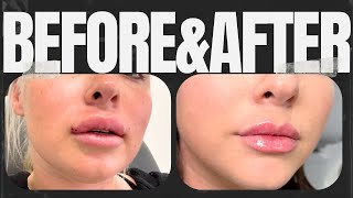 Getting My Lip Filler DISSOLVED