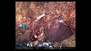 #271 Robotic Right Hepatectomy with Caudate lobectomy for Hilar Cholangiocarcinoma Dr R. Kalayarasan