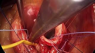 Aortic Valve Repair: Bicuspid Repair with External Subannular Ring