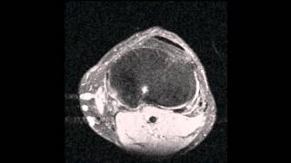 MRI of My Left Knee