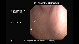 gastric ulcer #gastronautclinic #viral #endoscopy #healthcare #yt #gastro #patient #ulcer #health