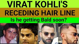 Is Virat Kohli going to be bald? CASE STUDY