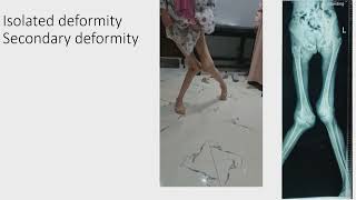 Deformity Correction part 3  - G Hosny