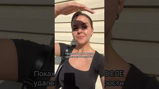 Подписывайся, скоро будет много историй про брекеты #shorts #брекеты #удалениезубамудрости