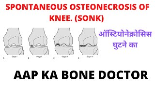 SPONTANEOUS OSTEONECROSIS OF KNEE - EPISODE 20