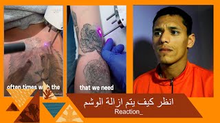 إزالة الوشم بالليزر - قبل وبعد خلال جميع المراحل  ( Reaction )