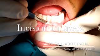 Chin Graft Harvesting