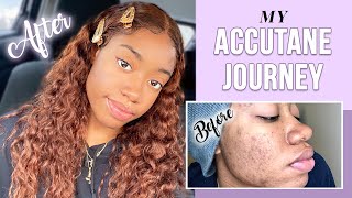 My Accutane Journey | Side Effects, Pros, & more