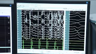 PVC Ablation  Live In box